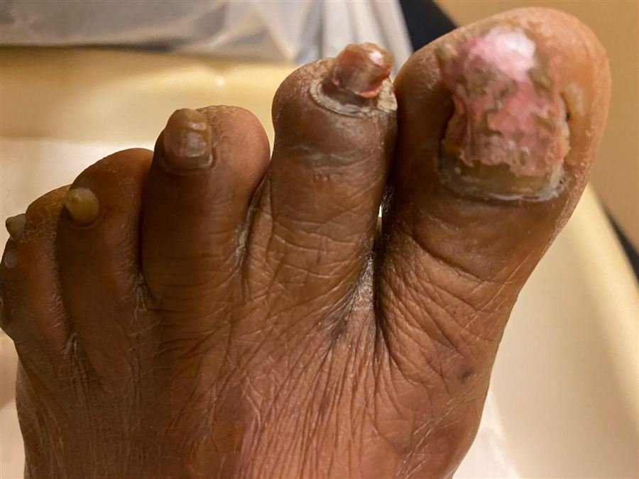 Thickened, discoloured toenails caused by a fungal nail infection