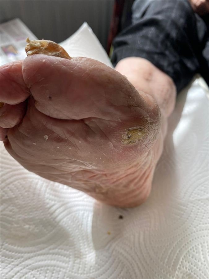 Thick, cracked hard skin built up around the heel