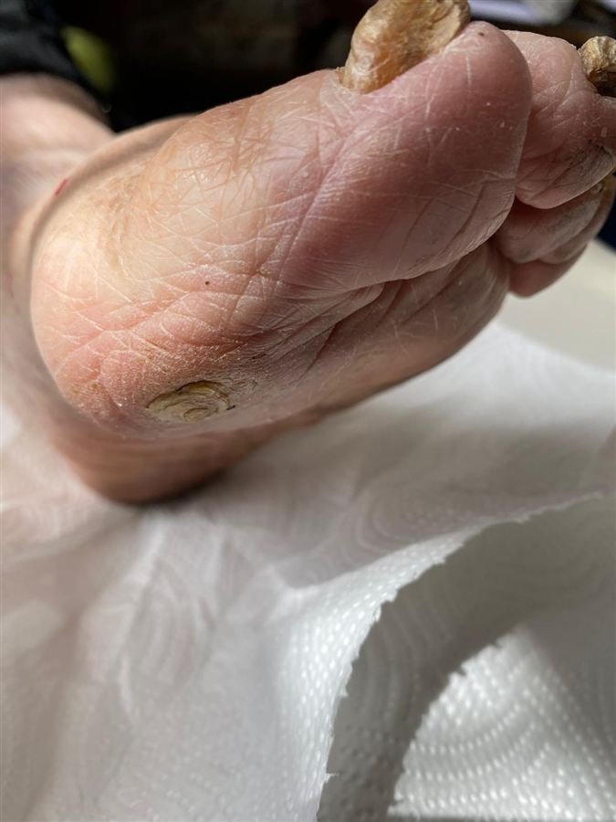 Hard skin and a small callus on the sole and heel