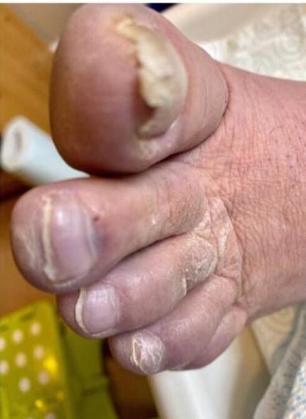 A thick, curved big toenail and dry hard skin between the toes before treatment